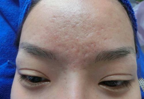 青春痘留下的凹凸不平的疤痕怎么才能恢复呢?