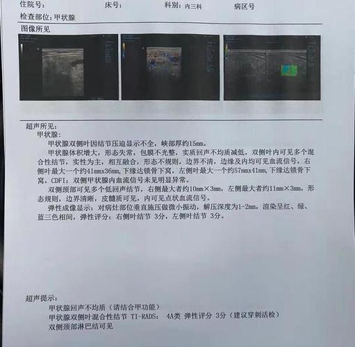 真实案例3年甲状腺结节从拇指盖大小长到鸡蛋大小