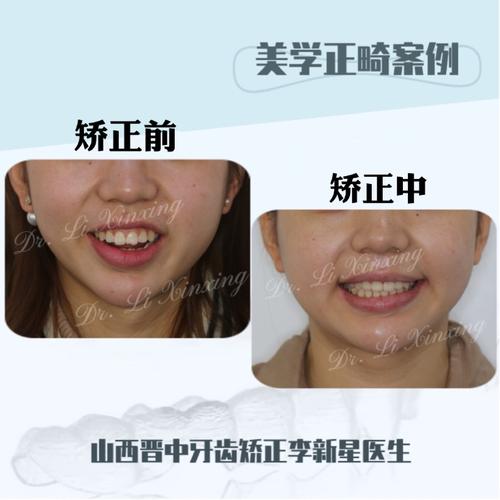 现在虽然还在矫正中,但姑娘的牙齿咬合关系基本恢复正常,面型也得到了