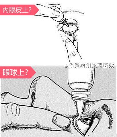 眼药水是滴在内眼皮上还是眼球上