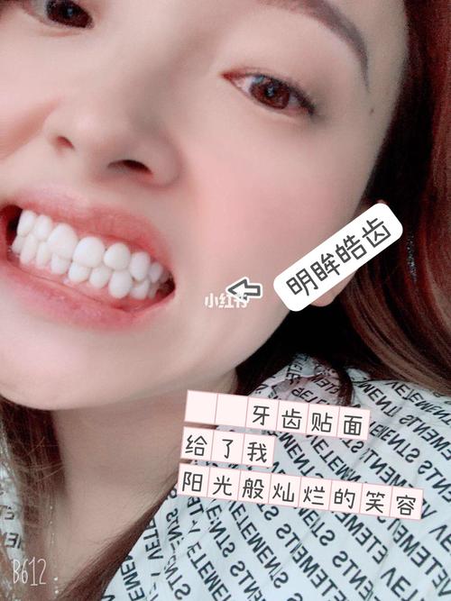 有一口美牙,才是真正的仙女_美牙_补牙_美女_牙齿贴面