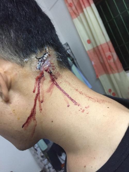 皮脂腺囊肿长在脸上了,医生说只能手术?