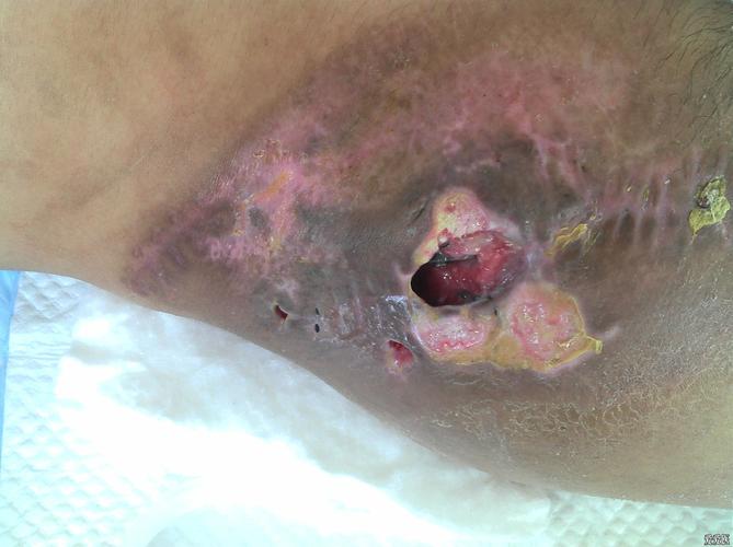 髂骨粉碎性骨折钢板内固定术后感染