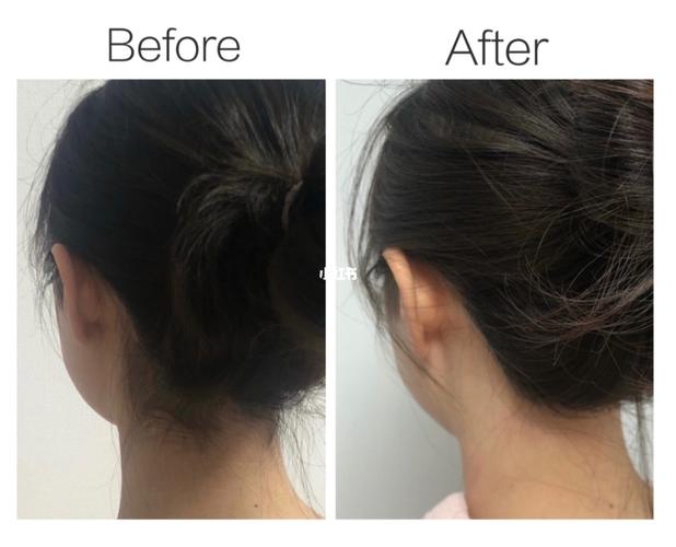 精致到后颈|后发际线激光脱毛 做了一次后发际线激光脱毛,效果真的很
