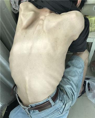 男孩患暴食症骨瘦如柴一顿吃200个饺子后狂吐不止