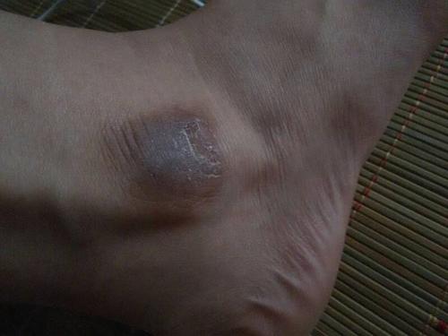 问:脚踝处莫名出现这个,感觉像疤痕,可是我好像没撞到哪,摸起来硬硬的
