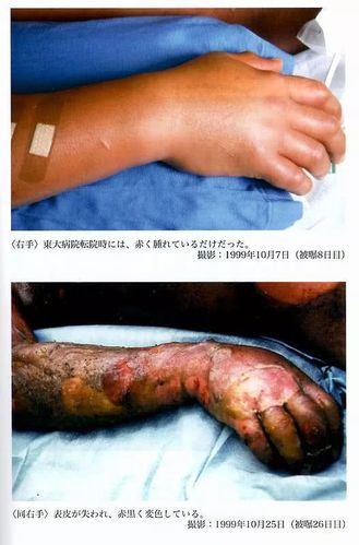 日本工人大内久遭受到致命核辐射被强行救活了83天最后痛苦死去