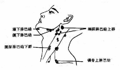 恶性肿瘤淋巴结转移:如肺癌可向锁骨上窝或腋窝淋巴结群转移