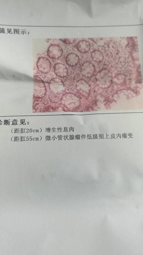 结果是距离肛20cm增生性息肉,距离55cm薇小管状腺瘤伴底级别上皮内瘤