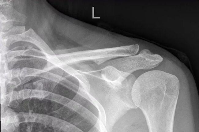 肩锁关节脱位的分型及治疗,值得收藏!