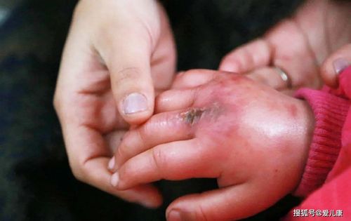 一个举动宝宝十指溃烂患了冻疮千万不能做这两件事