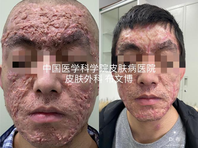 化脓性汗腺炎可以治疗,可以治愈