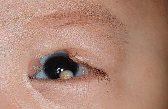 goldenhar 综合征的眼科诊疗