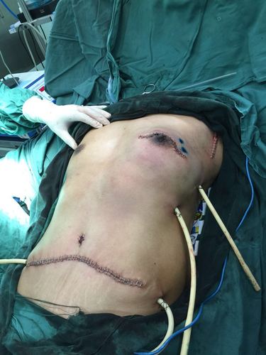 我院胸外科成功完成一例乳腺癌根治及一期乳房即刻再造术(tram)