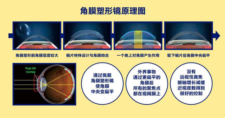 角膜塑形镜,近视少年不二之选