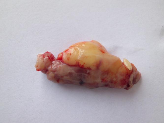 胃肠超声典型病例-----急性化脓性阑尾炎(超声,手术标本图)