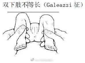 娃腿部畸形,只因一个习惯动作,90%父母都没在意!|宝宝