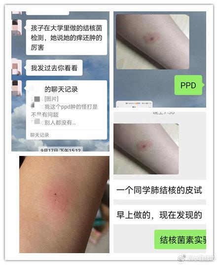 关于ppd试验