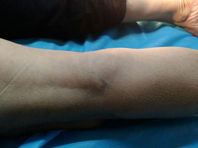 腘窝囊肿手术切除过程