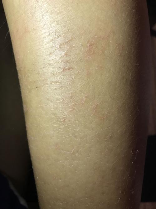 医院血液也查过,也没检查出是什么,之前皮肤一直很好,第一次出现.
