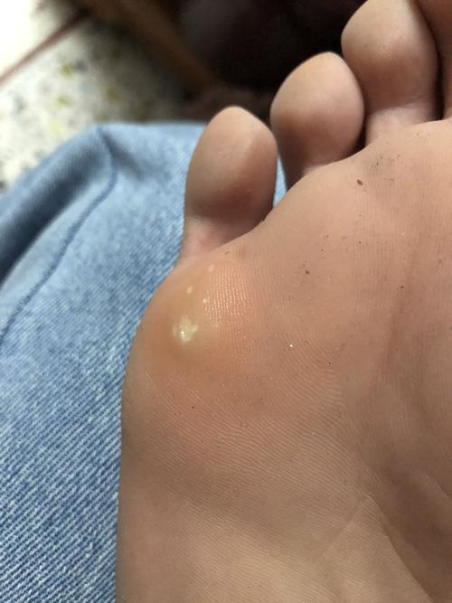 脚底长这个是什么,有时候会痛,但只是一点点痛,是白色
