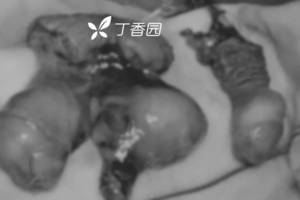 抑郁症患者切下自己的阴茎和睾丸,医生是如何.