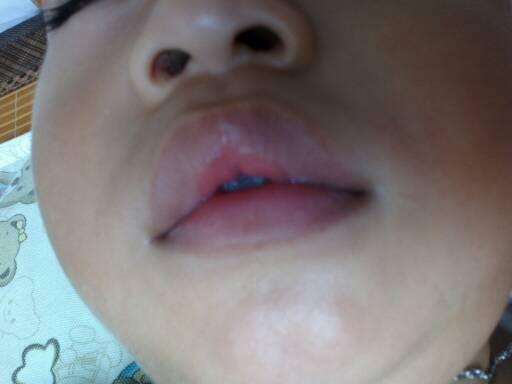 宝宝嘴唇颜色不一样,有明显的分界