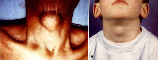 如何治疗甲状舌管囊肿?一文读懂鉴别诊断及手术要点!