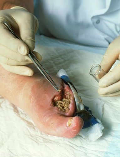 蛆虫清洗伤口.外科医生戴着手套,在一个病人的脚上放了一个蛆.