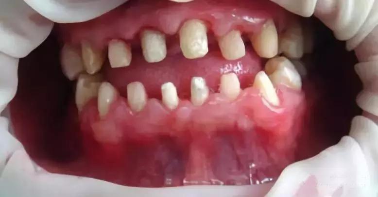 不要因为便宜而随便选择烤瓷牙