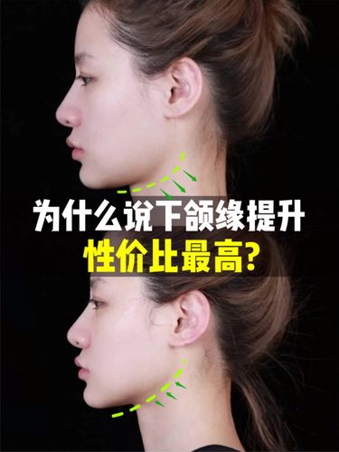 圈子里的jm有很多都去做了下颌缘,面基了其中的一位看到了真实效果!
