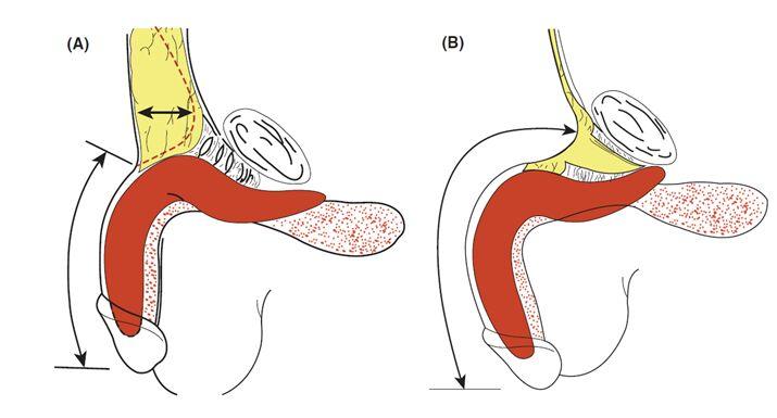男性阴茎延长手术的原理?会不会造成勃起功能障碍?
