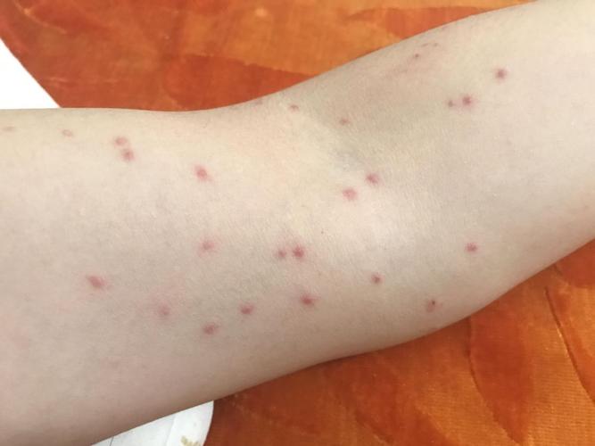 原创过敏性皮炎是怎样形成的?它的发病机制是什么?这些常识可告诉你