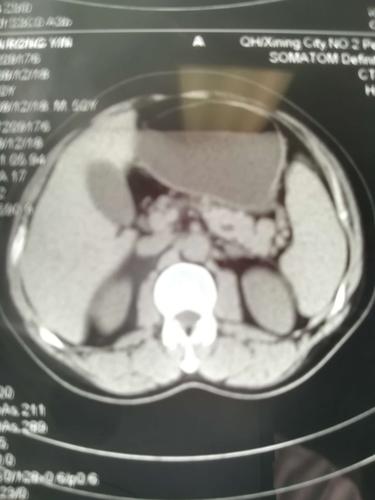 患者中老年男性,诊断:左侧腰疝