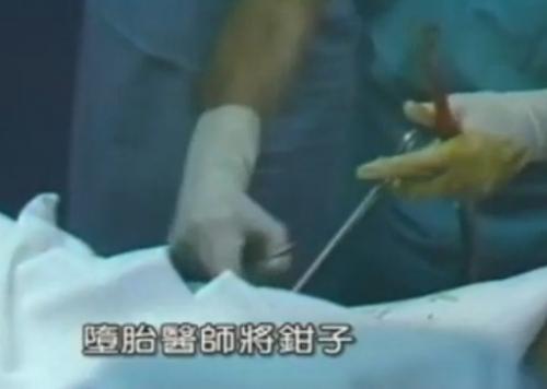 实拍美国堕胎手术全过程