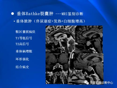 垂体rathke裂囊肿mr表现