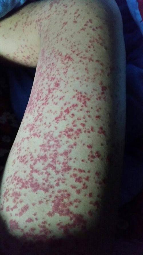 求皮肤科医生 原来查过过敏源是肉,过年没有忌口.