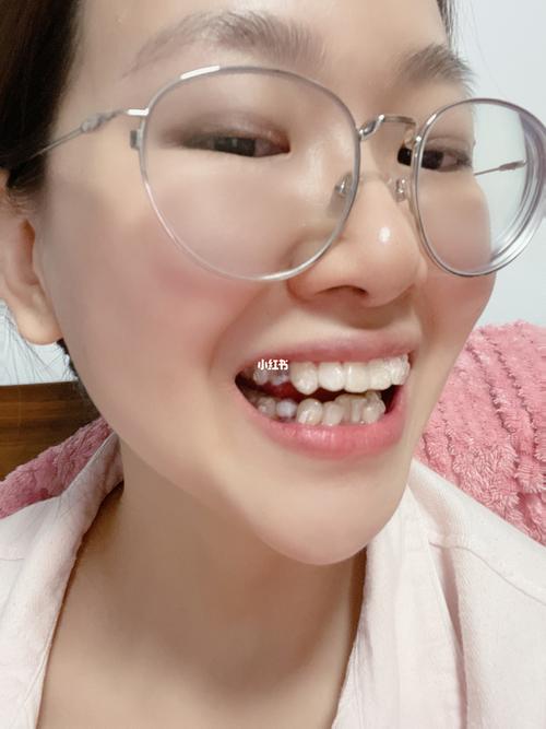带上了第一副隐适美牙套……_牙套_隐适美怎么样_牙齿矫正_正畸_美妆