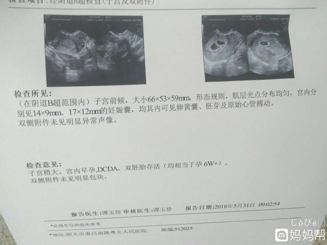 b超回来,是双胞胎