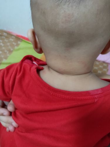 宝宝脑袋跟脖子后面起的红点脖子里也有 还一直用手抓