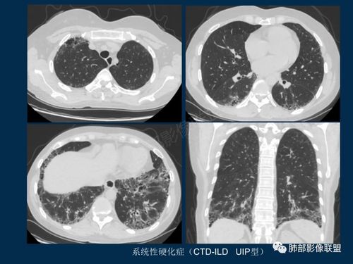 特发性间质性肺炎的病理影像特点