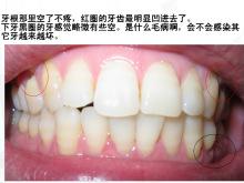 齿龈