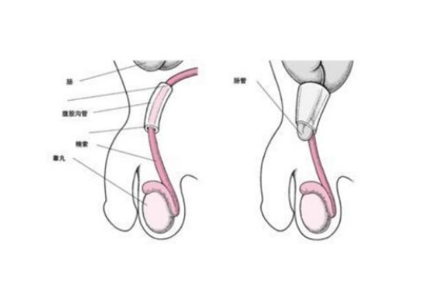睾丸囊肿一旦长出来就不会自己消失,部分患者还会不断的增大,所以大家