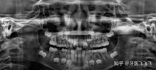 看牙齿的x光片如何看出牙齿是恒牙还是乳牙?