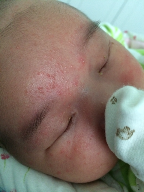 宝宝21天了脸上突然长了不知道是脂肪粒还是热疹,请各位帮帮忙谢谢了