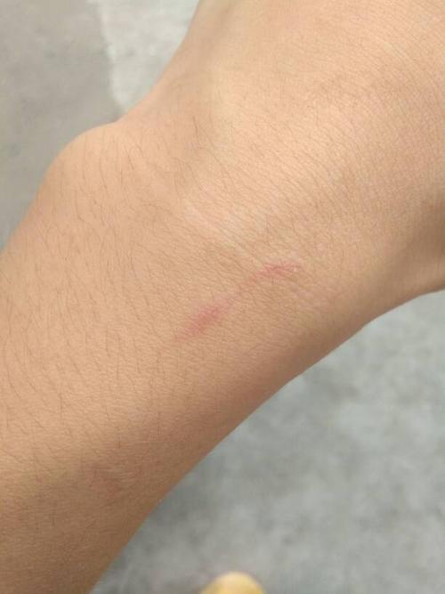 手上有一道伤痕,三个小伤口,请问这是什么回事啊,会不会是被老鼠抓了