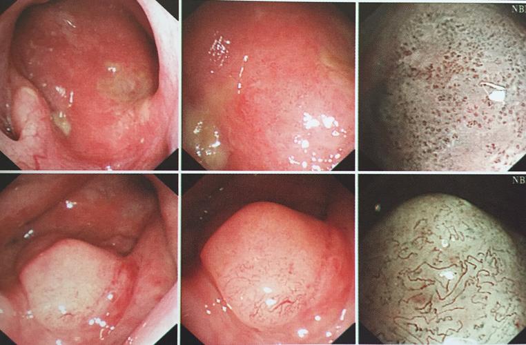 这是鼻咽癌肿瘤的改变.