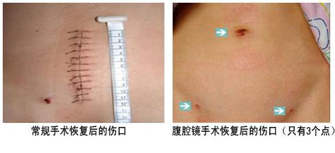 青岛子宫肌瘤的治疗方法 推荐新阳光微创技术