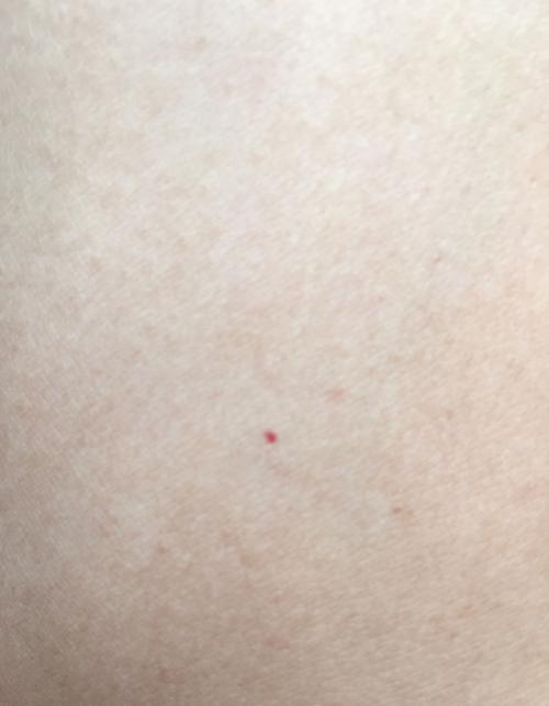 身上胳膊上有很多小血点,不疼不痒,好几年了,小的和针尖,大的有1毫米