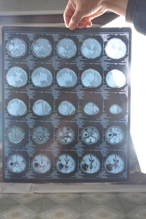 一个月婴儿脑部磁共振片子,求知情人解婴儿得了什么脑部疾病?